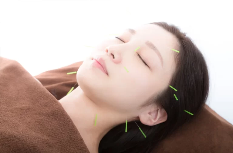 美容鍼について