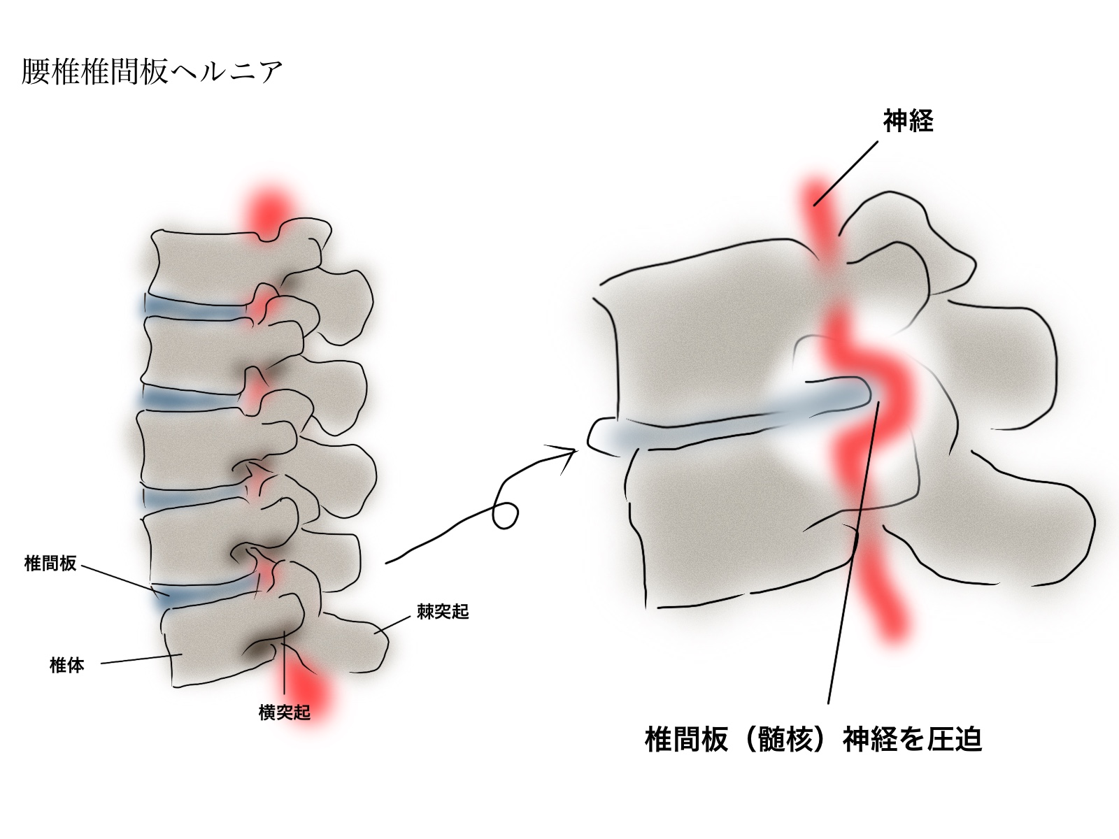 腰椎椎間板ヘルニア説明図